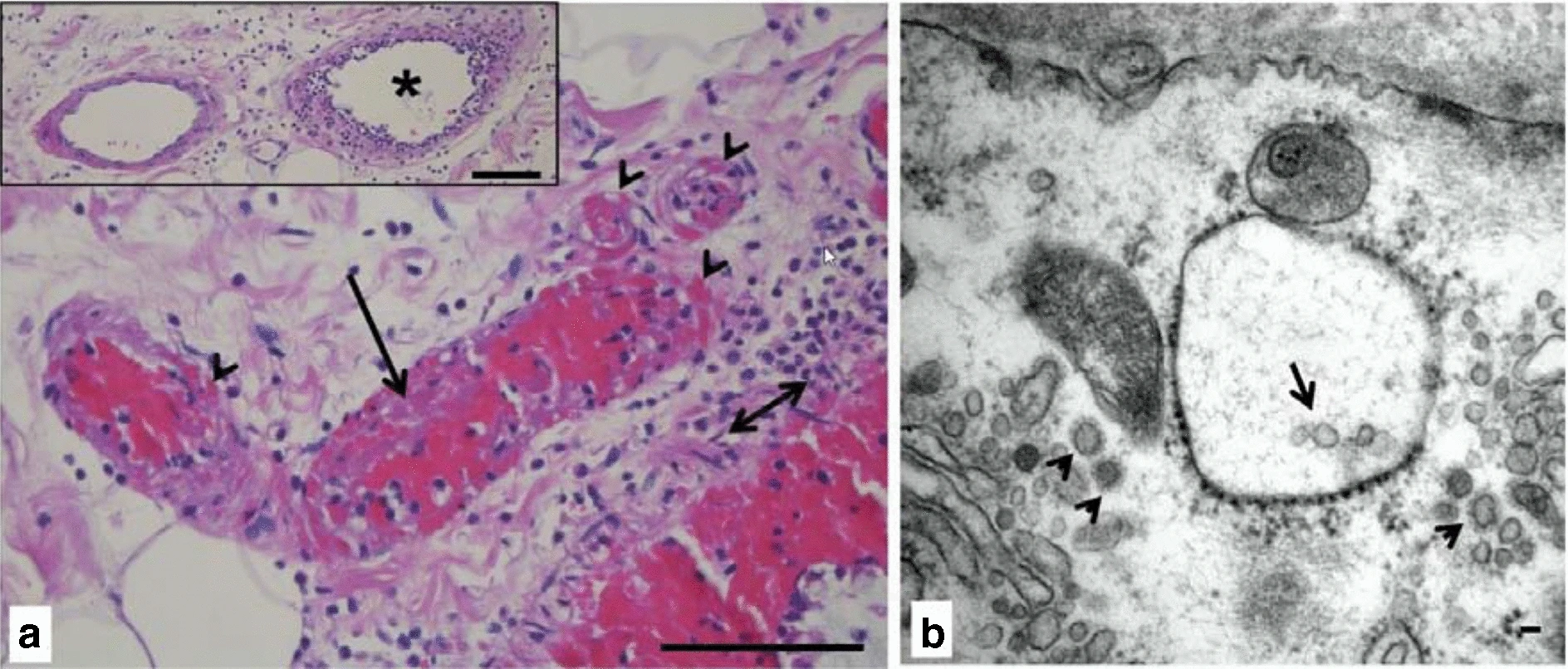 Elektronenmikroskopie: Endothelialitis, Mikrothromben und SARS-CoV-2-Partikel im Darmgefäß