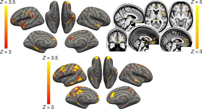 SARS-CoV-2: Reduktion der kortikalen Dicke und Veränderungen der Hirnstruktur in MRT-Analysen, besonders im Parahippocampal Gyrus, orbitofrontalen Kortex, anterioren cingulären Kortex und weiteren Arealen
