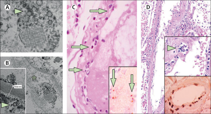 Elektronenmikroskopie: Endothelschäden und Mikrothromben bei COVID-19